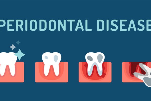 image of progression of periodontal disease