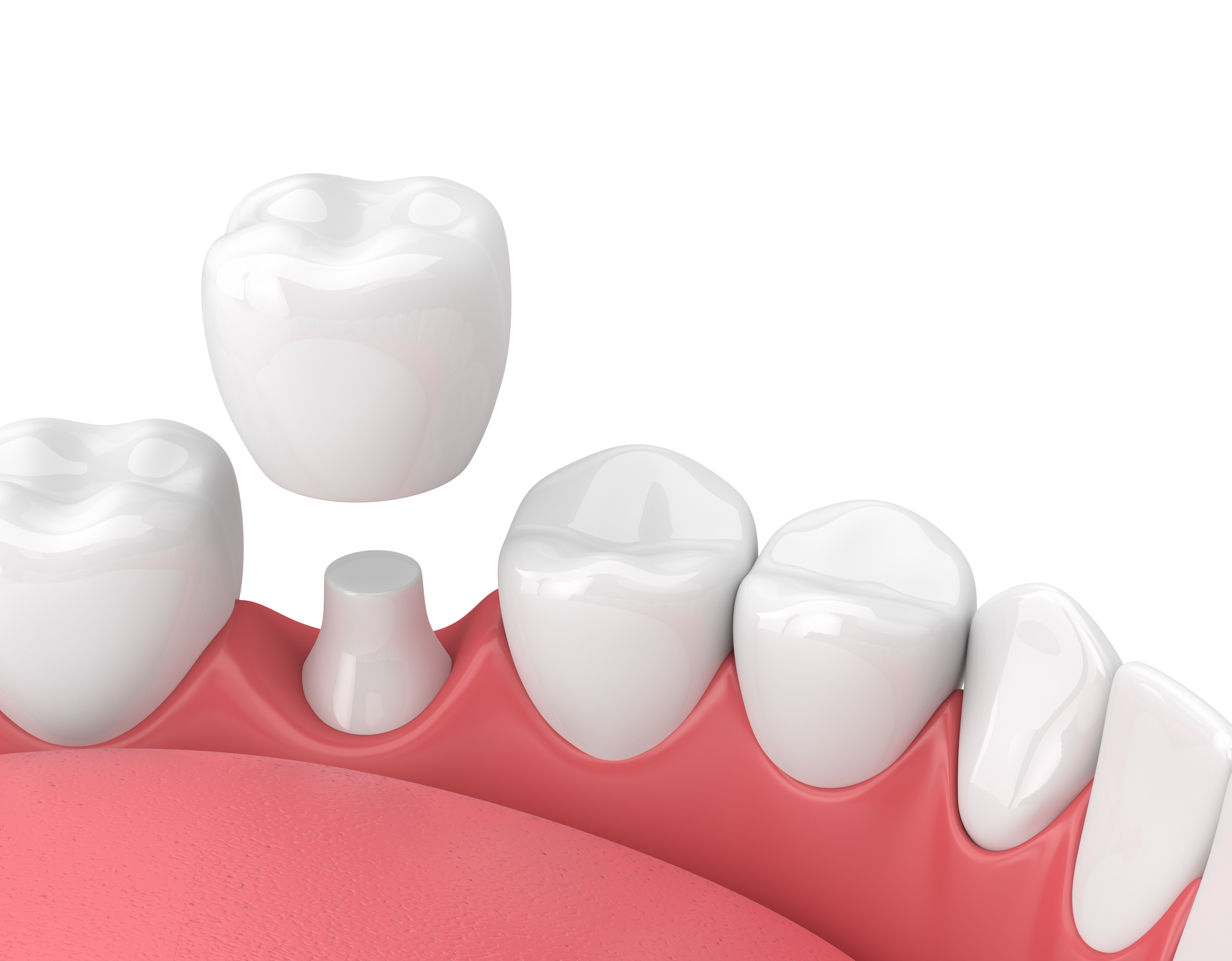 Metal-Free Crowns: Materials, Benefits, and the Procedure