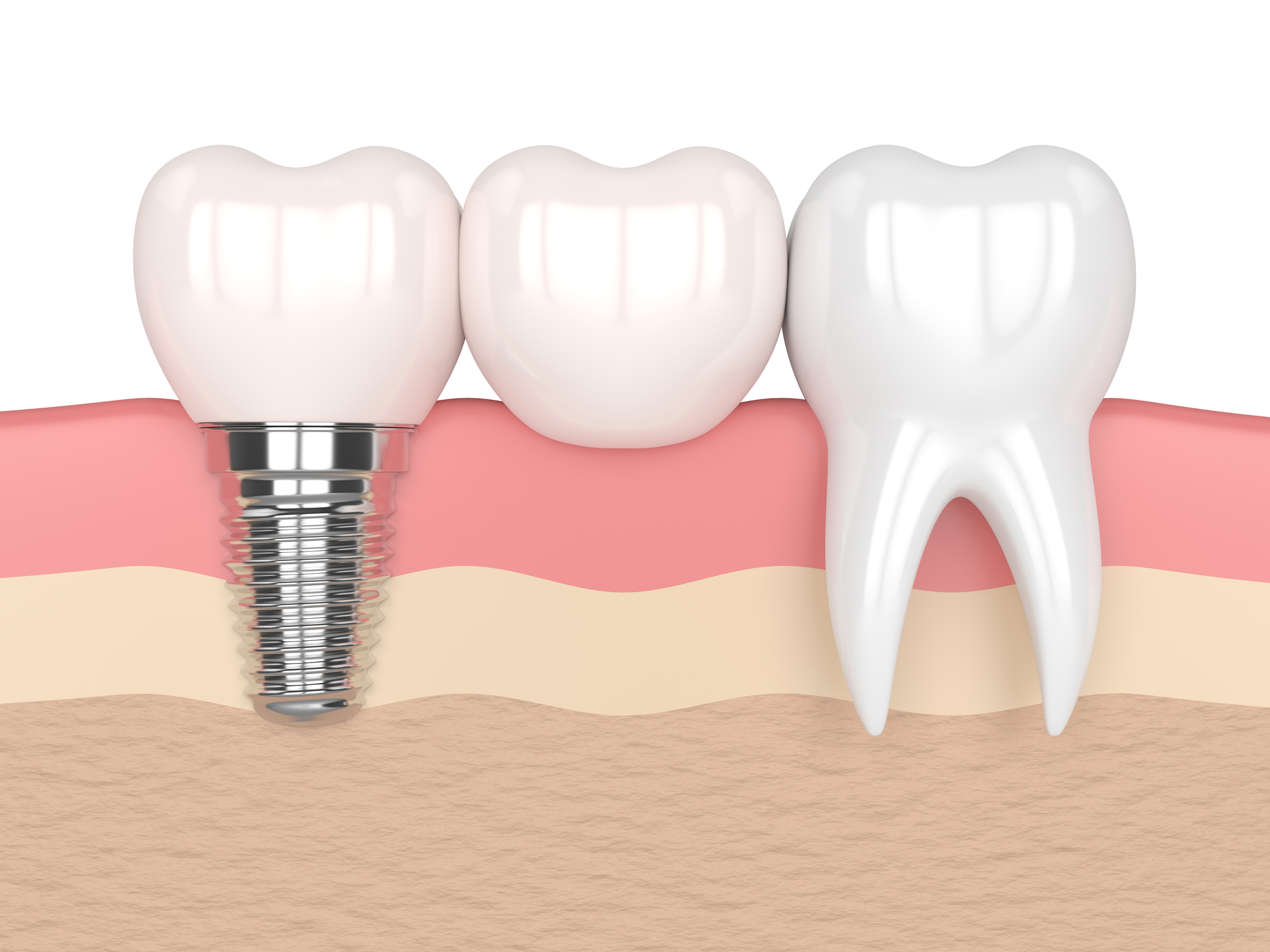 8 Benefits of Zirconia Dental Implants